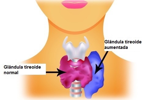 As doenças da tireoide como elas influenciam o seu corpo