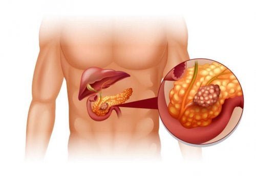 Tumores neuroendócrinos de pâncreas tratamento Melhor Saúde