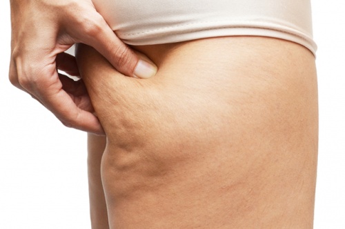 Remédios naturais para celulite