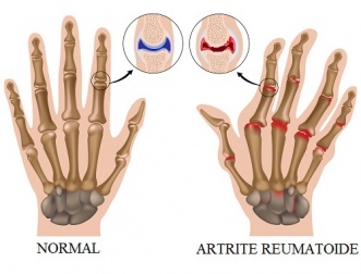 Artrite reumatoide: como controlar os sintomas