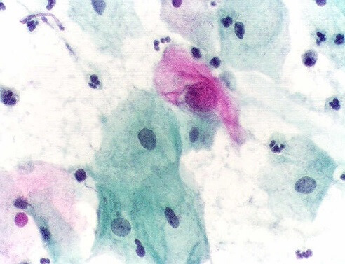 o HPV