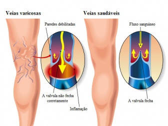 Tratamento caseiro para as varizes