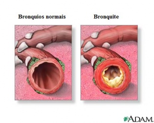 Tratamento natural para a bronquite