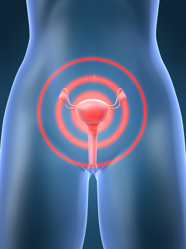 Cancer de utero-matriz