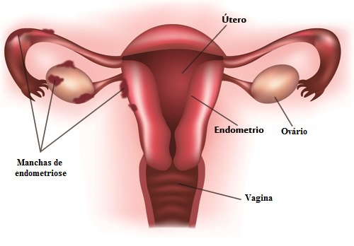 Os principais sintomas da endometriose