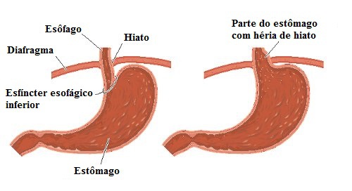 Remédios naturais para a hérnia de hiato