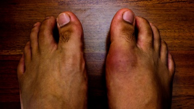 8 alimentos que podem causar a gota