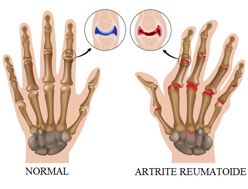 Rheumatoid arthritis of hand, eps8