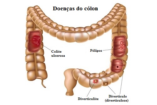 As doenças mais comuns do cólon, como preveni-las?