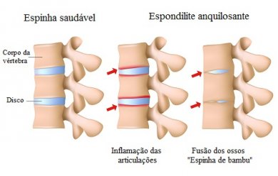 Espondilite anquilosante, você sabe o que é?