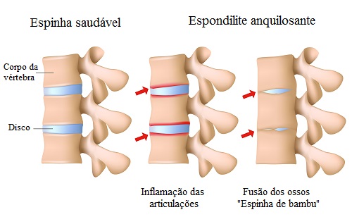 Espondilite Anquilosante, você sabe o que é? Espondilite Anquilosante, você sabe o que é?