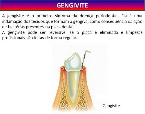 O que é gengivite?