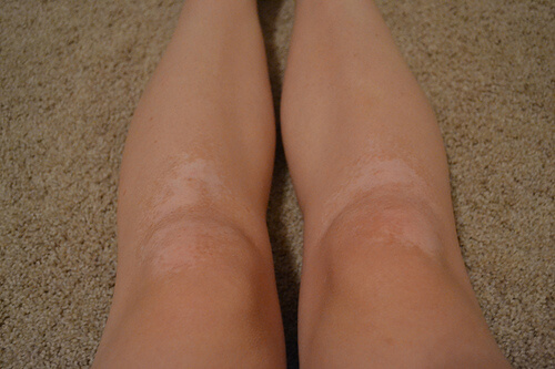 tratar o vitiligo