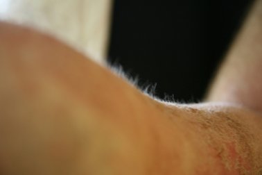 Saiba o que é dermatite atópica