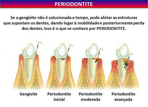 Definição de periodontite