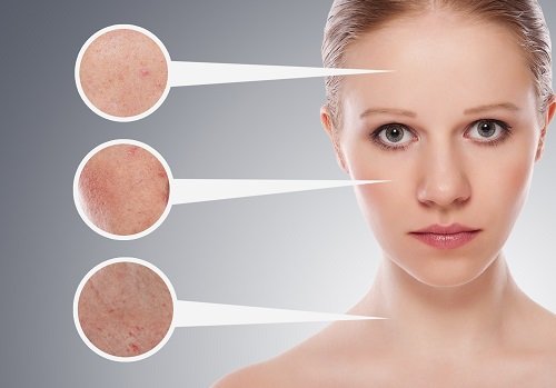 Entenda um pouco mais sobre a acne