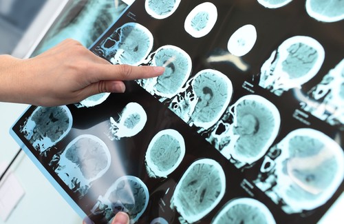 O Alzheimer pode ser evitado? O Alzheimer pode ser evitado?
