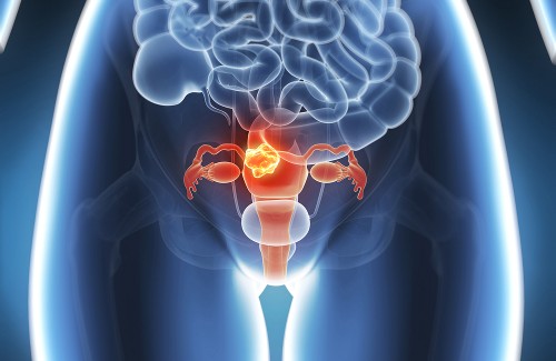 Alivio natural para a endometriose