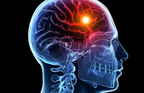Como prevenir o Acidente Vascular Cerebral? Como prevenir o Acidente Vascular Cerebral?