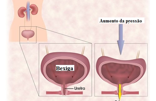Exercícios para a incontinência urinária da mulher Exercícios para a incontinência urinária da mulher