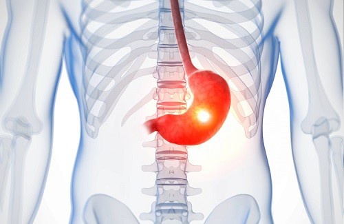 Intolerancia-a-lactose-500x325