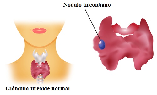 Como saber se um nódulo tireoidiano é benigno ou maligno?