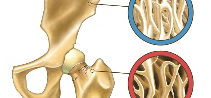 A osteoporose pode ser prevenida naturalmente A osteoporose pode ser prevenida naturalmente