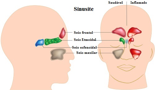 Como tratar a sinusite naturalmente