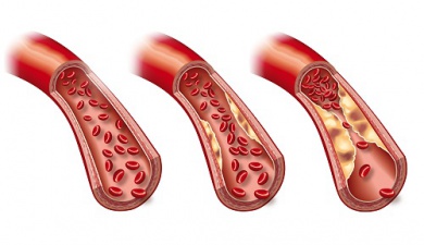 Arteriosclerose: sintomas e tratamento