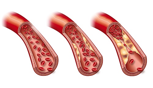 Veia com arteriosclerose em paciente com Doença de Crohn