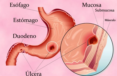 Tratamento natural para úlceras no estômago
