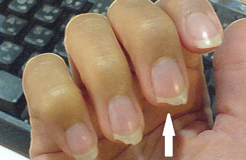 Unhas quebradiças: veja como evitar
