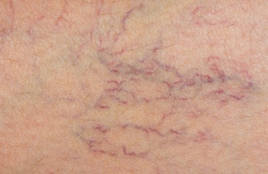 Castanha das índias, aliada contra as varizes