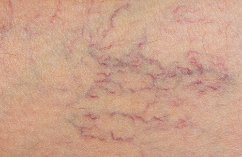 Varizes-500x325