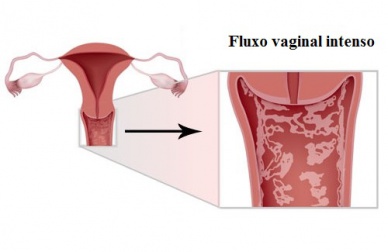 Sintomas, tratamentos e prevenção da vulvovaginite