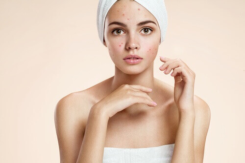Um dos tratamentos naturais com leite pode ajudar a tratar a acne