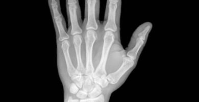 Existe cura para a artrite reumatoide?