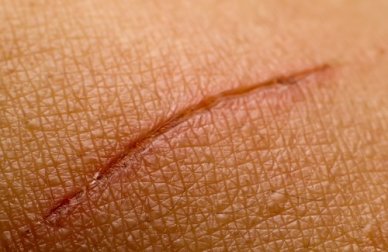 Remédios naturais para o tratamento das cicatrizes