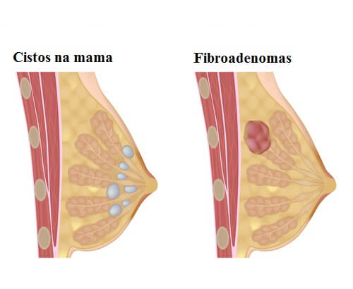 cistos mamários