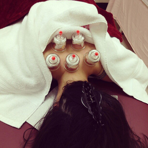 Terapia com ventosas ou cupping para contraturas nas costas