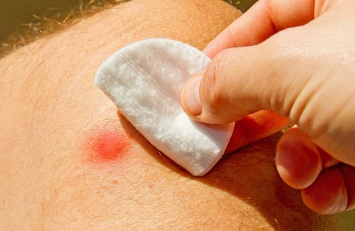 furúnculos veja como combater de forma natural