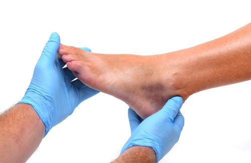 Inchaço nos pés e tornozelos: causas e prevenção