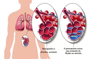 Pneumonia: sintomas e remédios naturais complementares