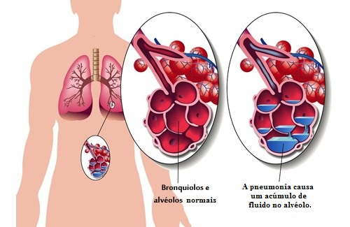 Pneumonia: sintomas e remédios naturais complementares Pneumonia: sintomas e remédios naturais complementares