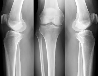 Dicas para combater a osteoporose