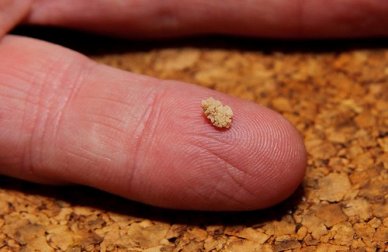 Remédios caseiros para dissolver as pedras nos rins