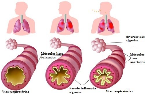 Asma e alergias: remédios naturais que podem nos ajudar