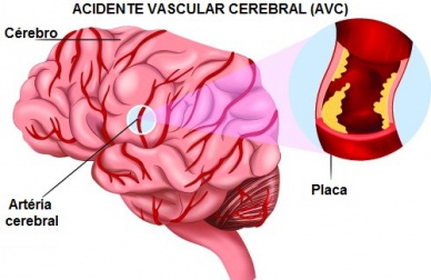 Conhecer os sintomas de um AVC pode salvar vidas