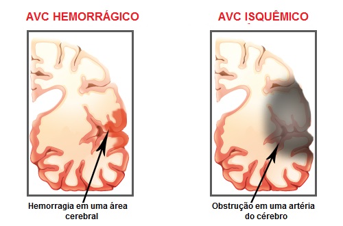 sintomas de um AVC