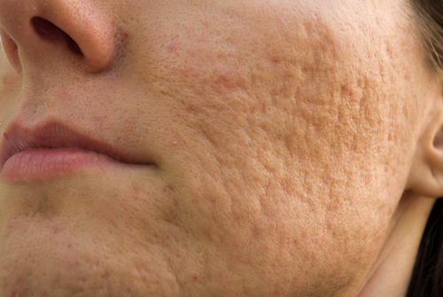 cicatrizes de acne